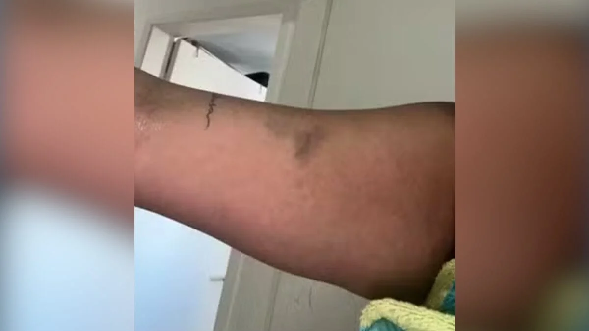 Namoradas mostraram marcas das agressões atribuídas ao influenciador (Foto: TV Globo, Reprodução)